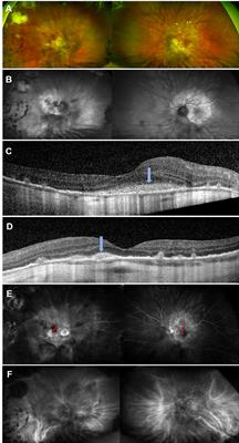 Case Report: Bilateral Choroidal Neovascular Membranes in a Patient With a Delayed Diagnosis of Acute Syphilitic Posterior Placoid Chorioretinopathy